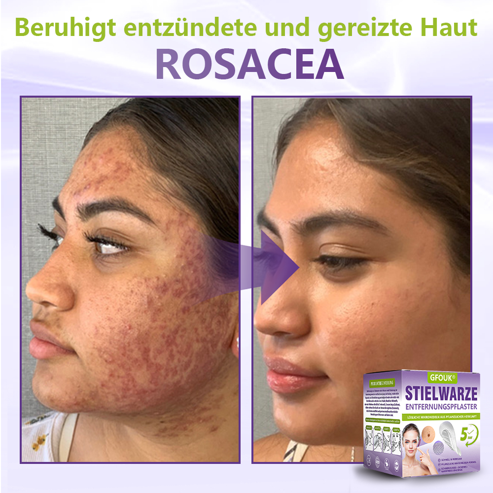 GFOUK® Lösliches Mikronadel-Pflaster zur Entfernung von Hautanhängseln auf Pflanzenbasis🏵️