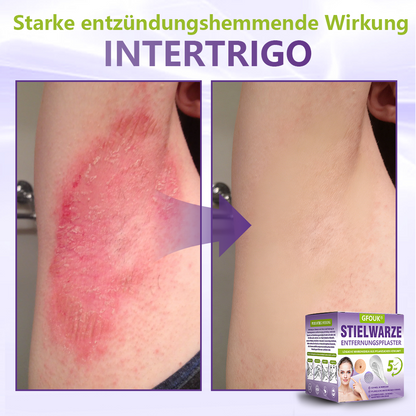 GFOUK® Lösliches Mikronadel-Pflaster zur Entfernung von Hautanhängseln auf Pflanzenbasis🏵️