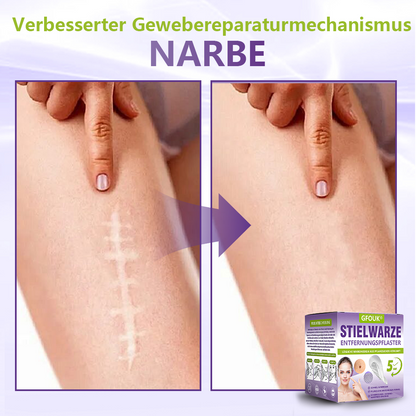 GFOUK® Lösliches Mikronadel-Pflaster zur Entfernung von Hautanhängseln auf Pflanzenbasis🏵️