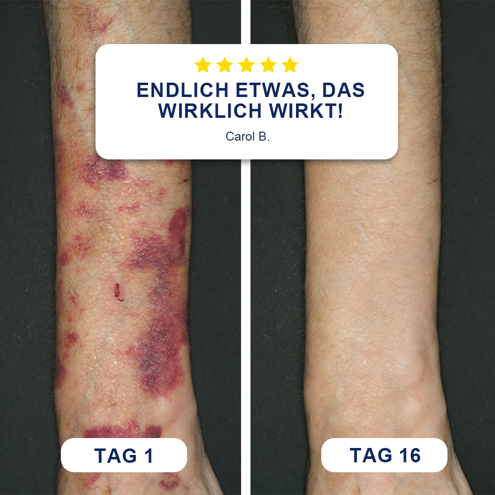 ✨Evolvion® Bluterguss-Reparatur- & hautstärkende Creme  (up)