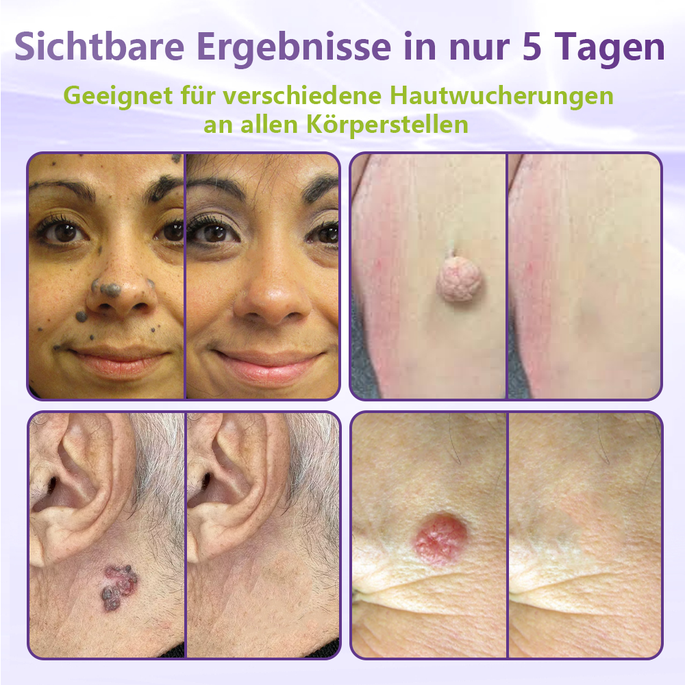 GFOUK® Lösliches Mikronadel-Pflaster zur Entfernung von Hautanhängseln auf Pflanzenbasis🏵️