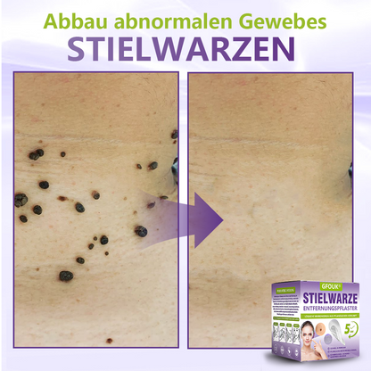 GFOUK® Lösliches Mikronadel-Pflaster zur Entfernung von Hautanhängseln auf Pflanzenbasis🏵️