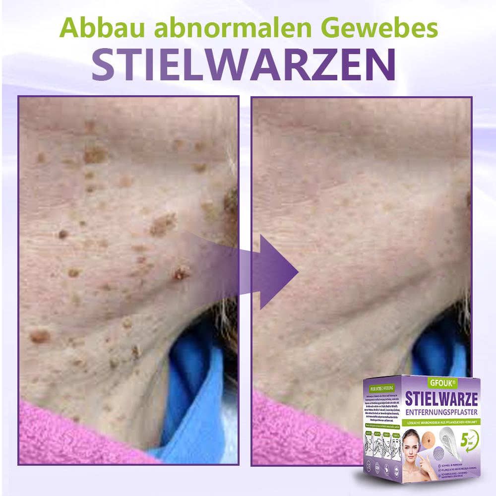 GFOUK® Lösliches Mikronadel-Pflaster zur Entfernung von Hautanhängseln auf Pflanzenbasis🏵️