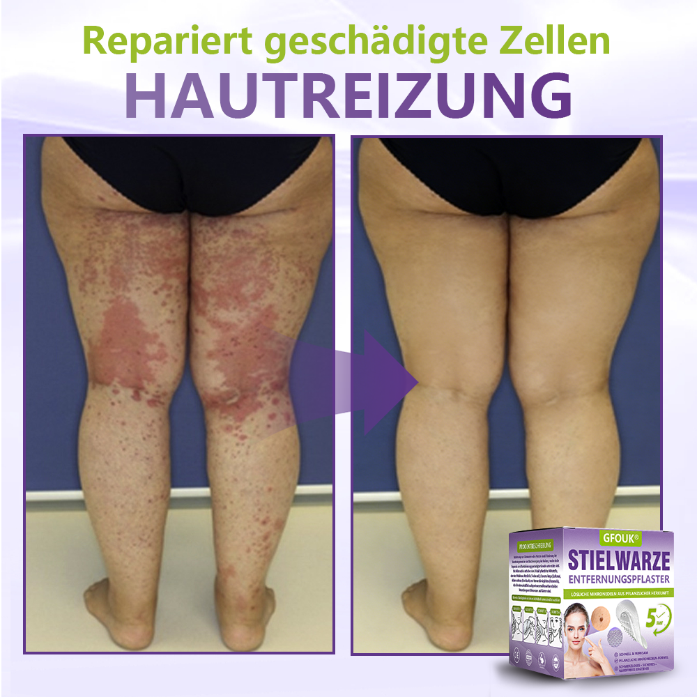 GFOUK® Lösliches Mikronadel-Pflaster zur Entfernung von Hautanhängseln auf Pflanzenbasis🏵️
