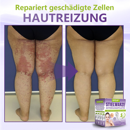 GFOUK® Lösliches Mikronadel-Pflaster zur Entfernung von Hautanhängseln auf Pflanzenbasis🏵️