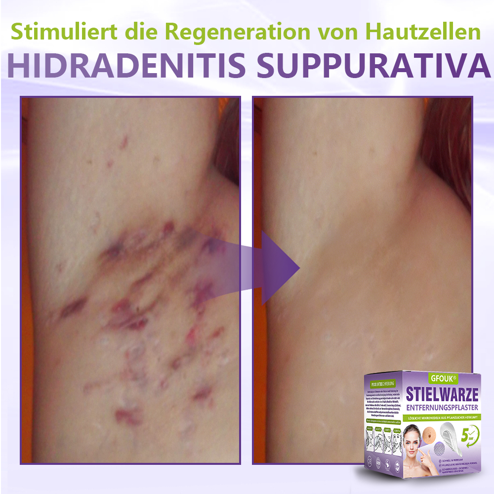GFOUK® Lösliches Mikronadel-Pflaster zur Entfernung von Hautanhängseln auf Pflanzenbasis🏵️