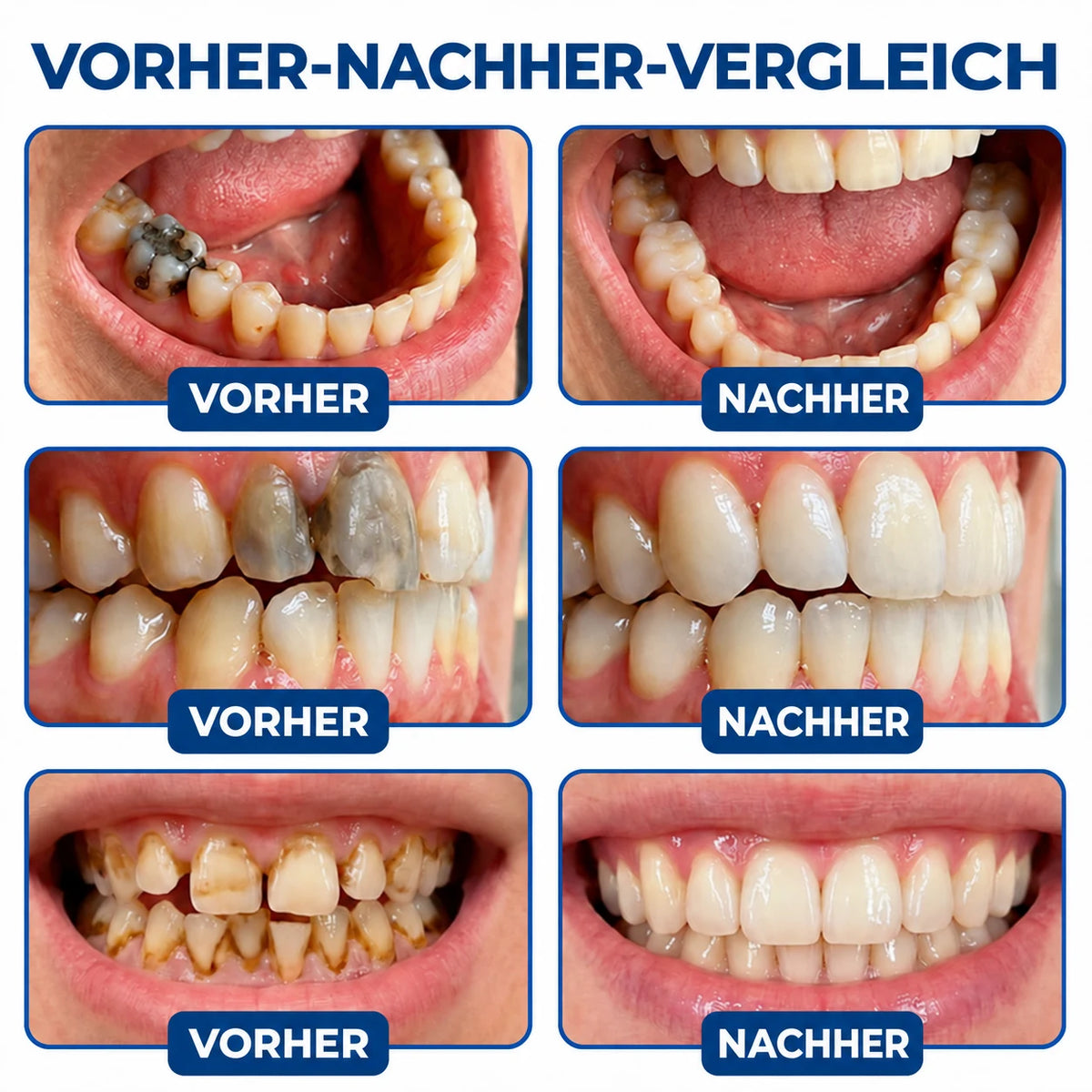 Dr.Fachmer® DentRestore Zahnreparatur- & Füllsystem🏆🏆