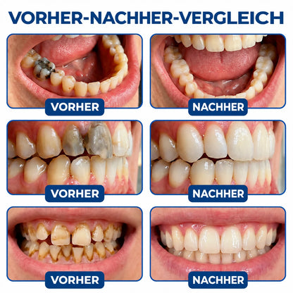 Dr.Fachmer® DentRestore Zahnreparatur- & Füllsystem🏆🏆